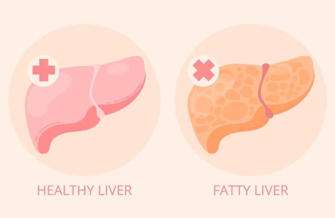 Liver Disease Rates Surge Across U.S.: Experts Weigh In on Possible Causes and Solutions