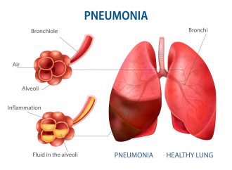 Pneumonia in Children