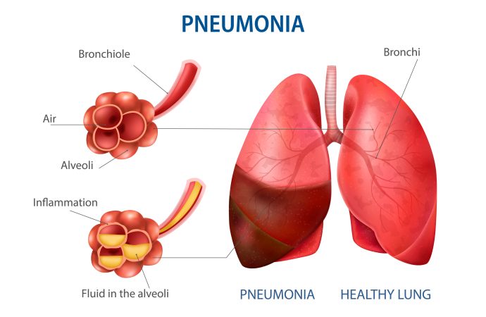 Pneumonia in Children