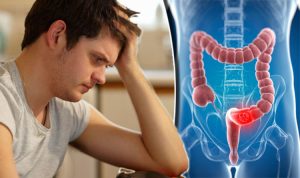 Colon Cancer in Young People