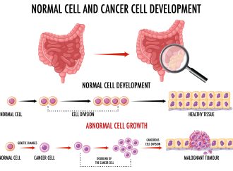 Colon Cancer on the Rise in Young People