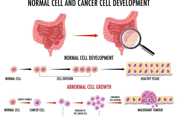 Colon Cancer on the Rise in Young People