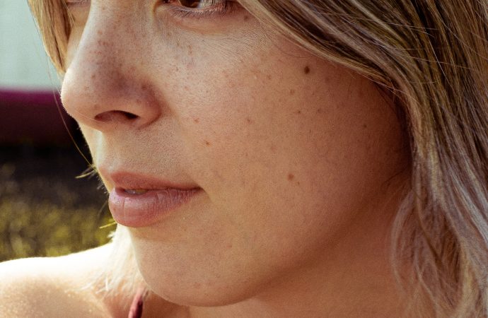 The Do’s and Don’ts of Treating Acne for a Radiant Glow