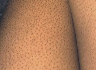 Get Rid of Bumpy, Uneven Skin with These 9 Must-Have Amazon Products