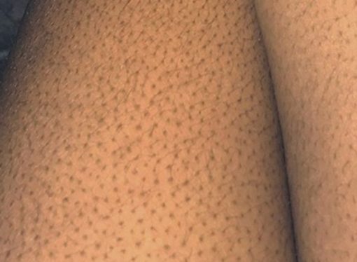 Get Rid of Bumpy, Uneven Skin with These 9 Must-Have Amazon Products