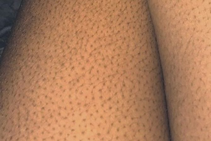 Get Rid of Bumpy, Uneven Skin with These 9 Must-Have Amazon Products