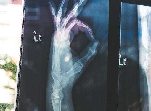 Living with an Arm Fracture Coping Strategies and Support Resources