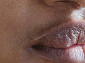 From Diet to Skincare: Identifying the Culprits Behind Your Stubborn Blackheads