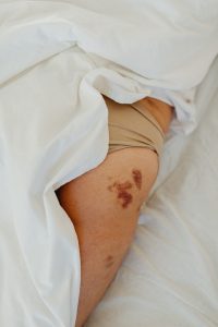 bruises
