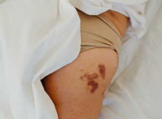 Recovery at Home DIY Methods to Speed Up Bruise Healing