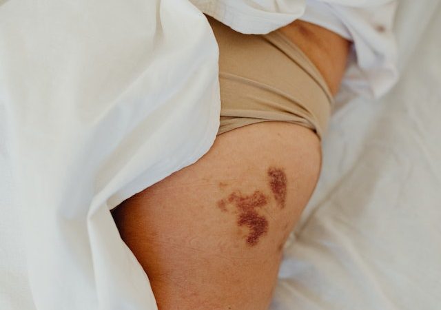Recovery at Home DIY Methods to Speed Up Bruise Healing