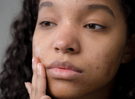 Breaking Down the Biggest Skincare Mistakes That Cause Acne