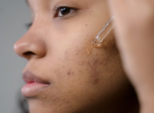 The Frugal Guide to Flawless Skin: 15 Affordable Acne Treatments