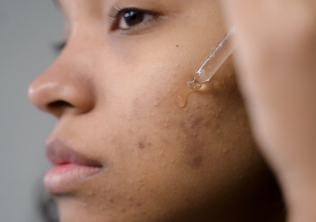 The Frugal Guide to Flawless Skin: 15 Affordable Acne Treatments