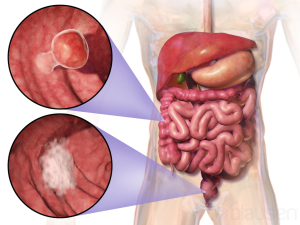 Colorectal Cancer