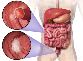 Unveiling Colorectal Cancer Uptick: Insights from Recent Research