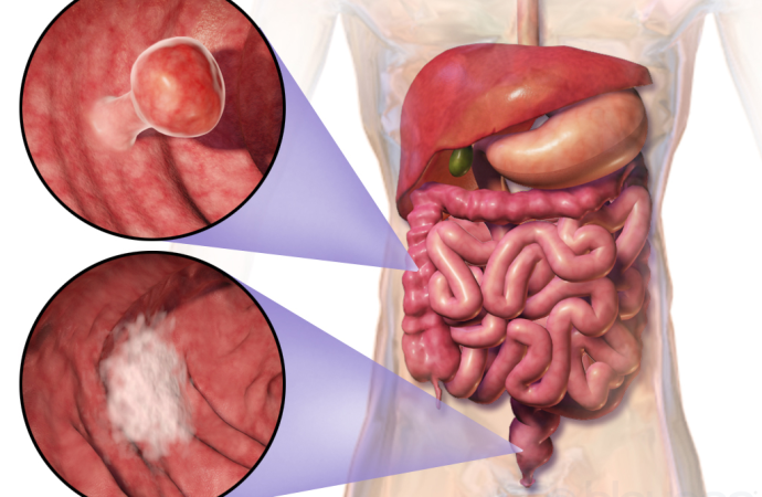 Unveiling Colorectal Cancer Uptick: Insights from Recent Research