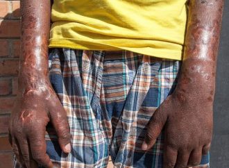 Leprosy in Central Florida: Hidden Endemic Cases