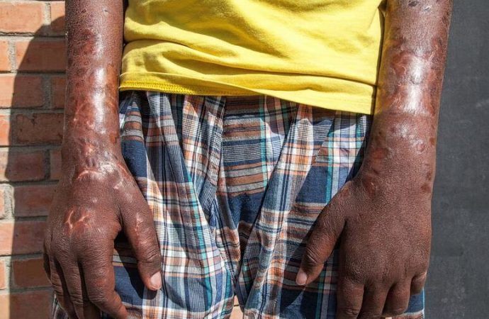 Leprosy in Central Florida: Hidden Endemic Cases