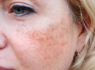 Beyond the Surface: Unraveling Hyperpigmentation and Melasma