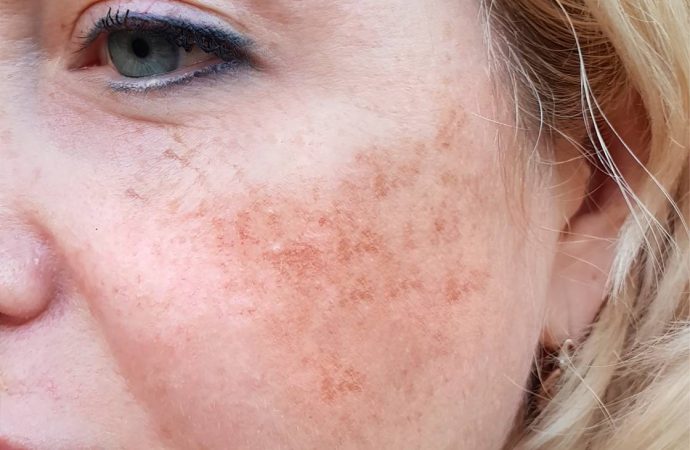 Beyond the Surface: Unraveling Hyperpigmentation and Melasma