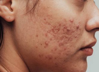 Unmasking Acne Secrets: 7 Proven Treatment Techniques for Clearer Skin