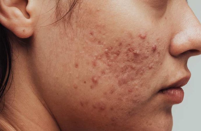 Unmasking Acne Secrets: 7 Proven Treatment Techniques for Clearer Skin