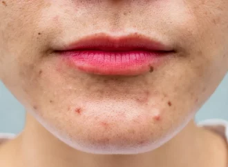 Conquer Hormonal Acne Across Ages