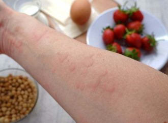 Navigating Food Allergies: Identifying Common Culprits