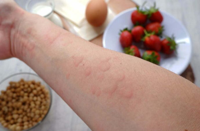 Navigating Food Allergies: Identifying Common Culprits