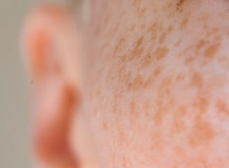 Ear Infections Causes, Symptoms, and Effective Treatments