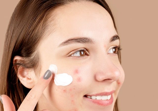 Clear Skin Secrets: 14 Effective Home Remedies for Acne