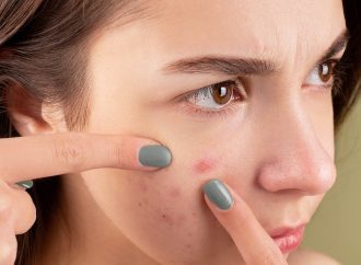 Top Acne-Fighting Skincare Products Tried and Tested