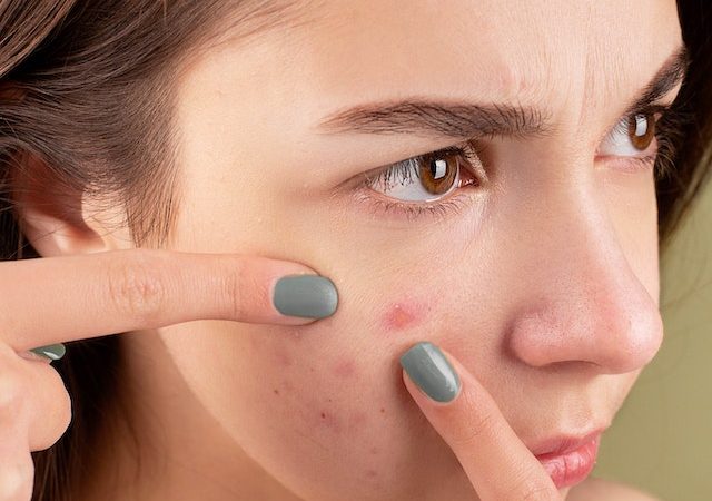 Top Acne-Fighting Skincare Products Tried and Tested