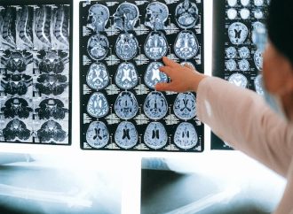 Guide to Understanding MRI Scans Principles, Procedure, and Benefits