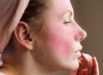 Gentle Solutions: Soothing Rosacea with Effective Home Remedies