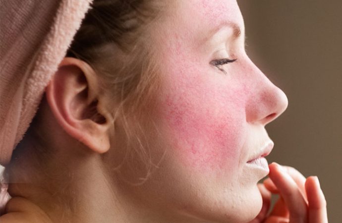 Gentle Solutions: Soothing Rosacea with Effective Home Remedies