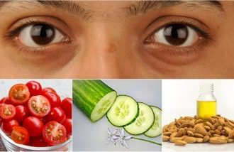 Bright-Eyed Beauty: Top Remedies for Banishing Dark Circles