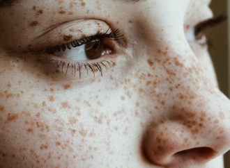 Freckles Unveiled: Causes, Remedies, and Beyond by Dr. Harold Lancer