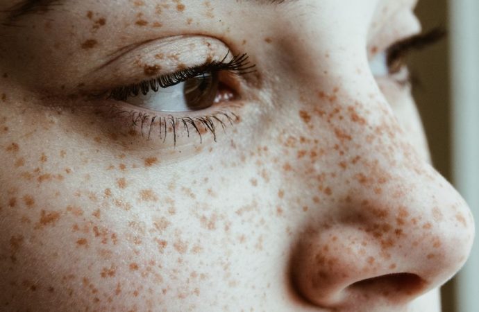 Freckles Unveiled: Causes, Remedies, and Beyond by Dr. Harold Lancer