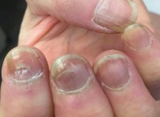 Decoding Nail Health: What Your Fingernails Reveal About Your COVID-19 Journey