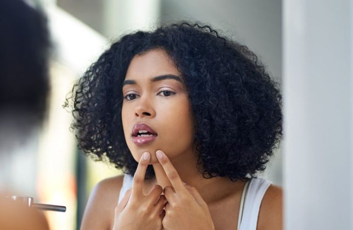 Clearer Skin Awaits: Avoid Acne Don’ts with Rosemary Gladstar’s Tips