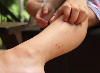 Scratch-Free Secrets: 5 Easy Home Remedies to Calm Mosquito Bite Itch