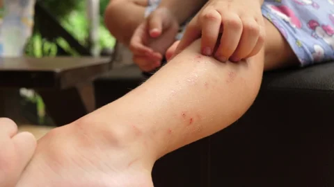Scratch-Free Secrets: 5 Easy Home Remedies to Calm Mosquito Bite Itch