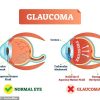 A New Dawn for Glaucoma Patients: Real-Life Gene Therapy Success
