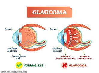 A New Dawn for Glaucoma Patients: Real-Life Gene Therapy Success