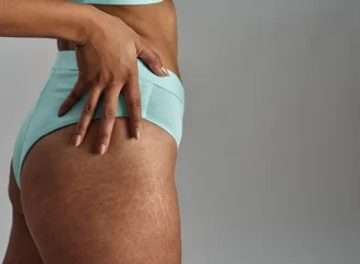 Striking a Balance: Susun Weed Decodes the Origins and Holistic Remedies for Stretch Marks