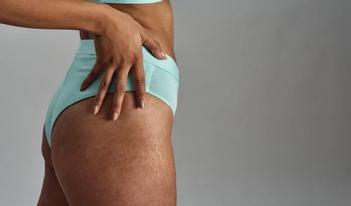 Striking a Balance: Susun Weed Decodes the Origins and Holistic Remedies for Stretch Marks