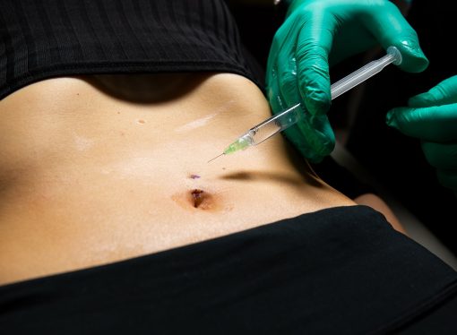 What to Know Belly Button Reconstruction Surgery?