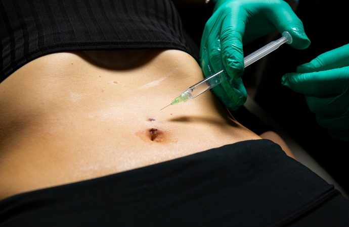What to Know Belly Button Reconstruction Surgery?